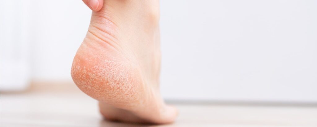 Piedi Screpolati in Estate: Come Intervenire e Ripristinare la Tua Pelle